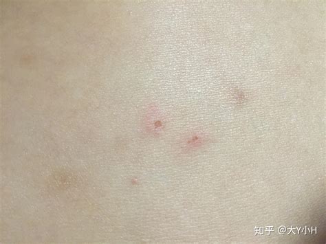 丘疹性荨麻疹消退过程