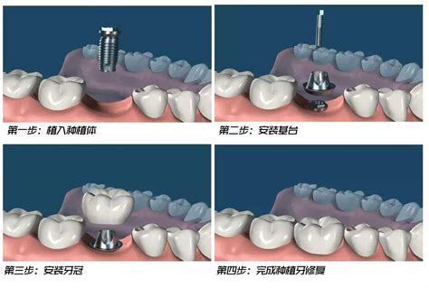 什么叫种植牙齿过程