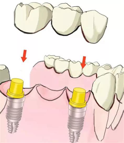传统固定义齿和种植牙区别