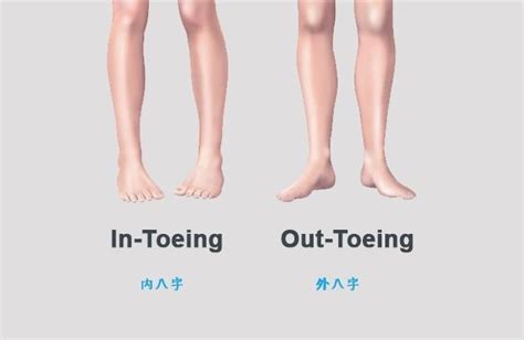 儿童内八字x型腿如何治疗