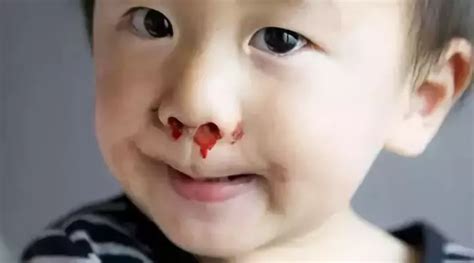 儿童十岁流鼻血是什么原因
