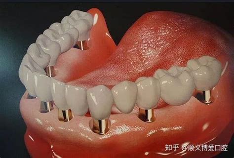 全口牙种植要种哪个部位比较好