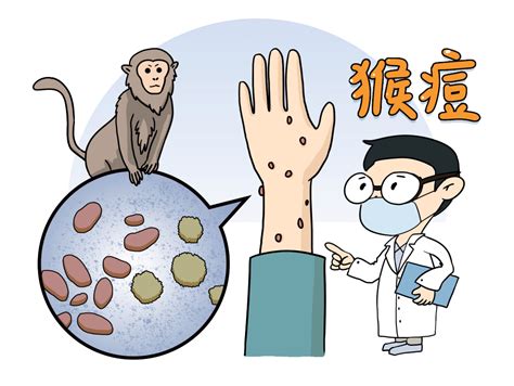 北京已有多少例猴痘