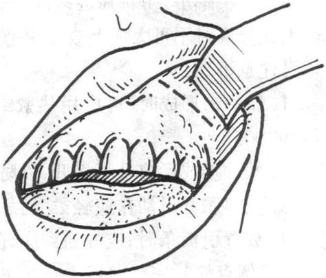 口腔引流手术一般几天可以恢复