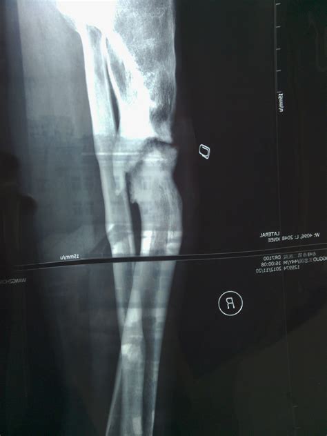 大腿骨折做手术五个月腿又痛