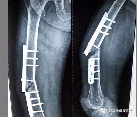 大腿骨摔断了做手术了多久能走