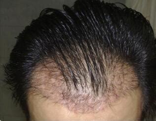 头发种植后遗症有哪些