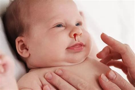 小孩经常流鼻血的原因