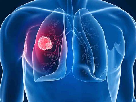 小细胞肺癌转移到腹部能活多久