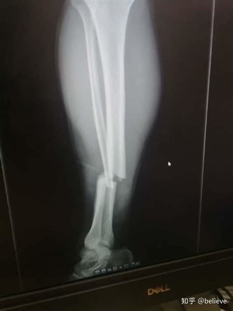 小腿断了做手术7天后走路了
