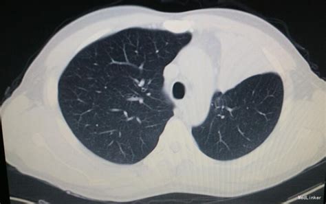 左肺上叶中央型肺癌