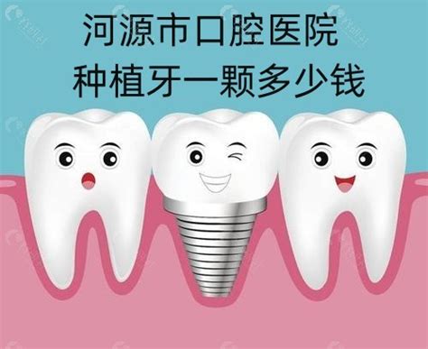 广州公立医院种牙价格多少钱一颗