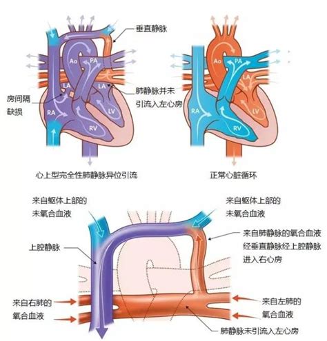 心下型肺静脉异位引流