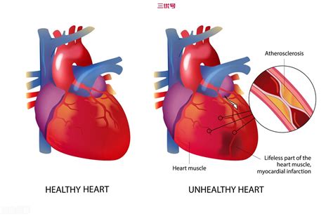 心脏梗塞一般能活多久