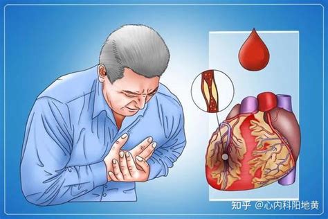 心脏梗塞是什么症状
