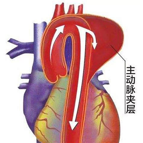心脏腔梗怎么治