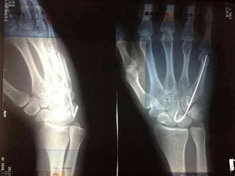 手腕骨折5个星期恢复到什么程度了