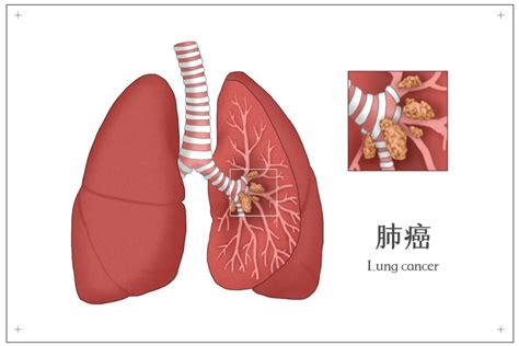 早期肺癌6种信号