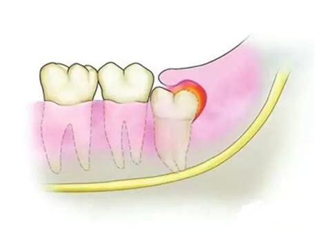 智齿冠周炎能刷牙吗