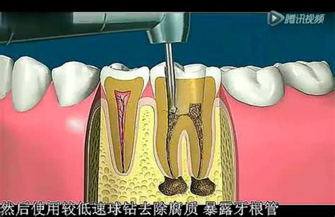 根管治疗后牙齿还能“活”多久图片