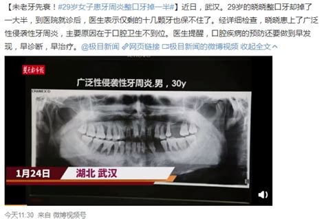 武汉29岁女子整口牙掉了一半