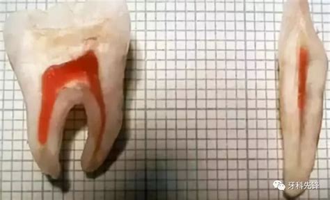 牙体开髓视频