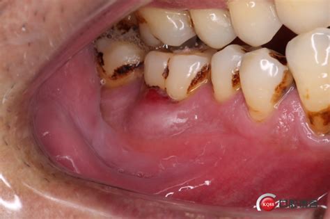 牙槽脓肿切开引流步骤