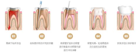 牙髓炎根管治疗步骤图