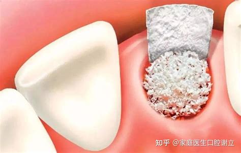 牙齿植骨粉成功率
