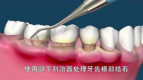 牙龈出血牙周病怎么治