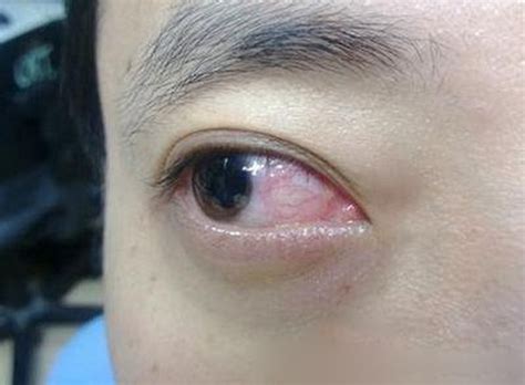 皮肤过敏会引起眼睛肿吗
