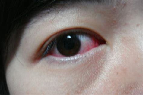 眼睛周围反复红肿过敏