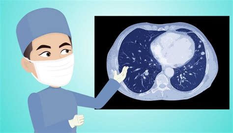 磨玻璃结节95%都是肺癌吗