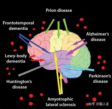 神经性退行性疾病伴脑铁沉积