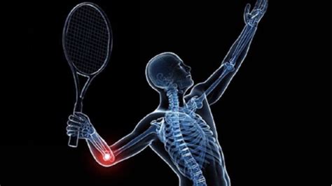 网球肘的三种类型