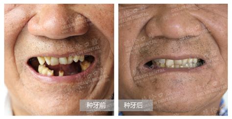 老人种牙的条件