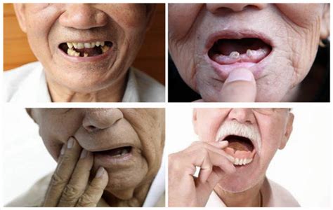 老人能不能种牙