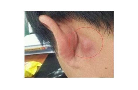 耳朵后面老是长痘是什么原因