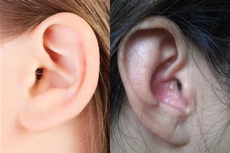 耳朵周围长很多痘是怎么回事