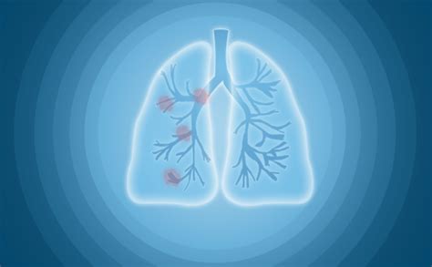 肺上有结节和打疫苗有关系吗