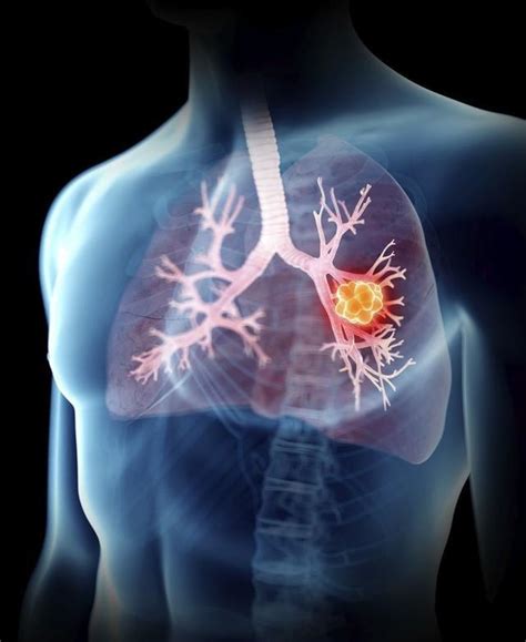 肺癌中最严重的癌症是什么