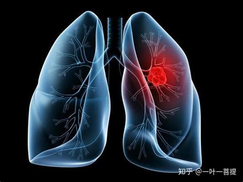 肺癌初期有什么症状