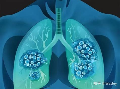 肺癌抗原偏高多少为癌症