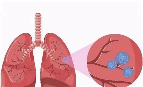 肺结节是肺癌前兆吗