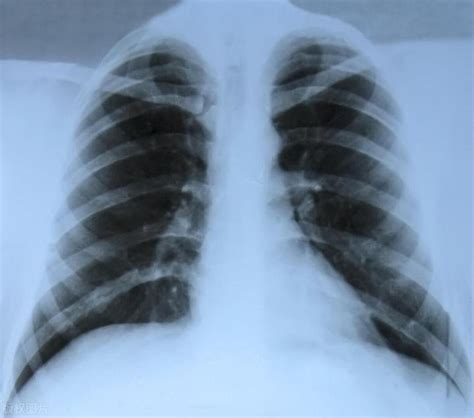 肺部有阴影一般是什么情况