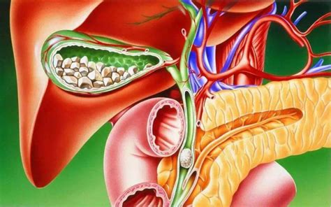 胆管支架和胆管内引流有什么区别