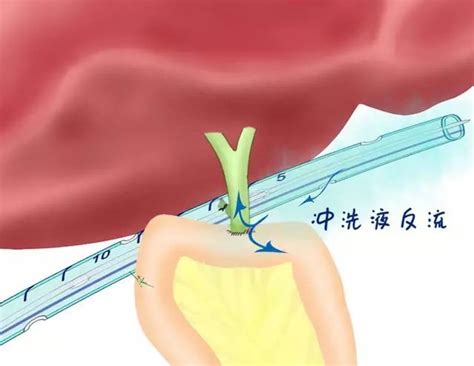 腹腔引流管操作方法