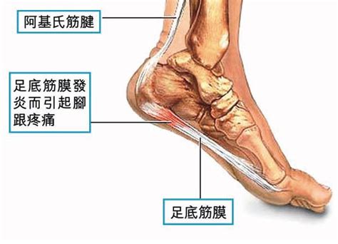 跖腱膜炎和足底筋膜炎区别