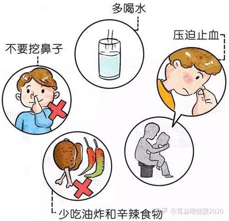鼻出血应急措施