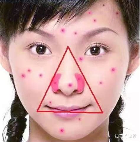 鼻子周围经常长痘的原因